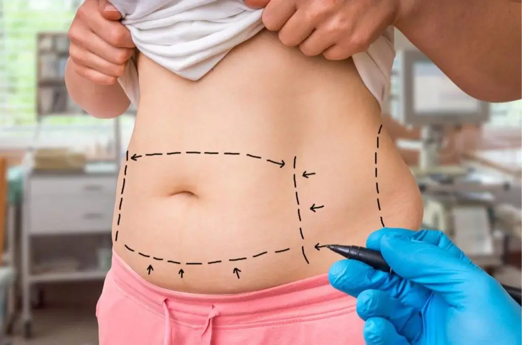 Is exercise required after liposuction?